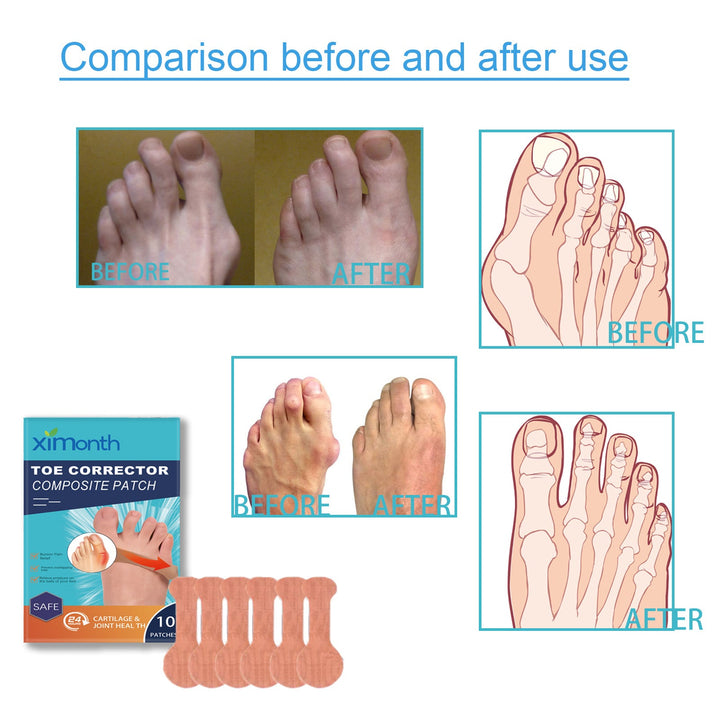 Bunion Corrector Patches for Big Toe Pain Relief
