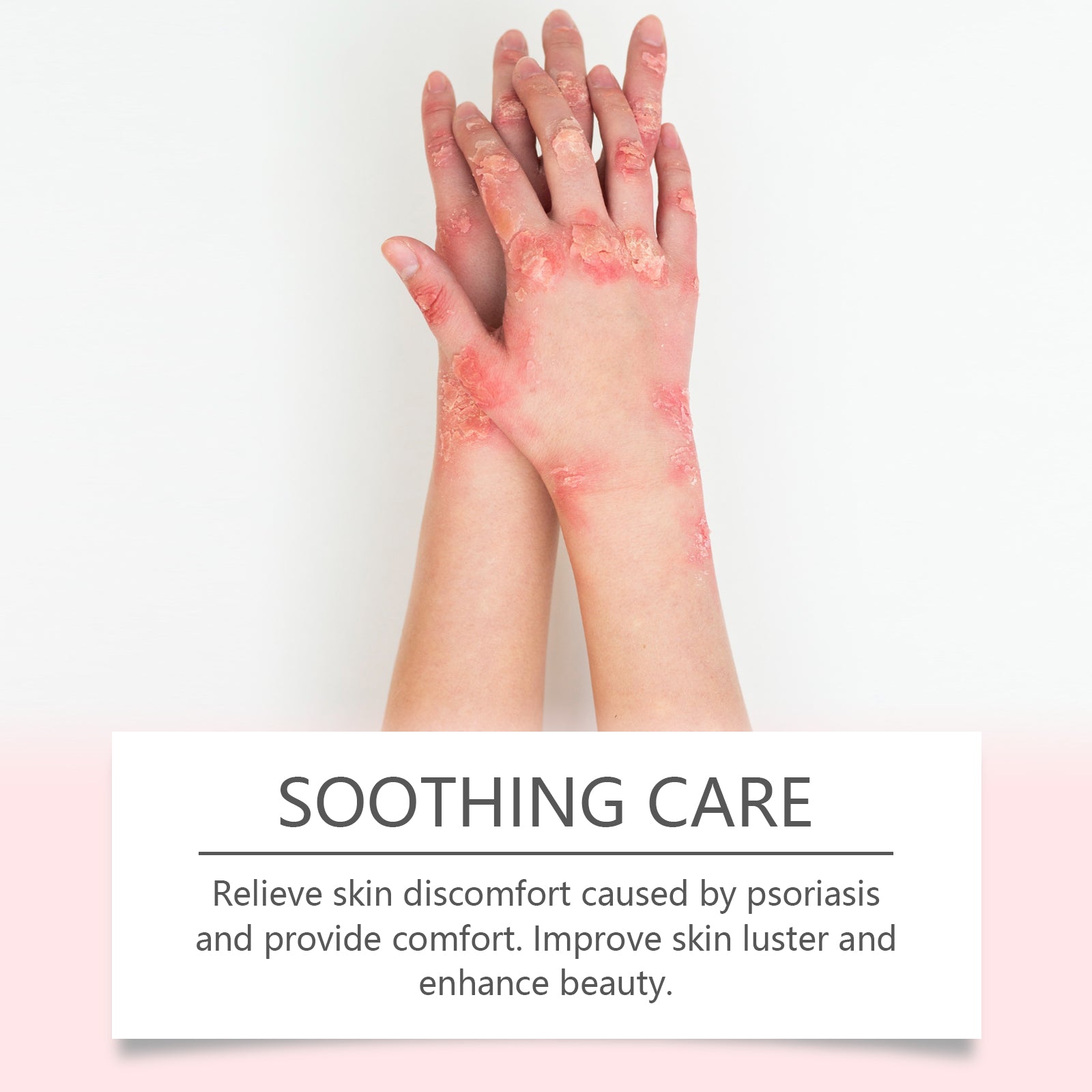 Hands showing severe psoriatic coverage with pink, scaly patches, with Soothing Care tagline below describing relief and skin luster improvement