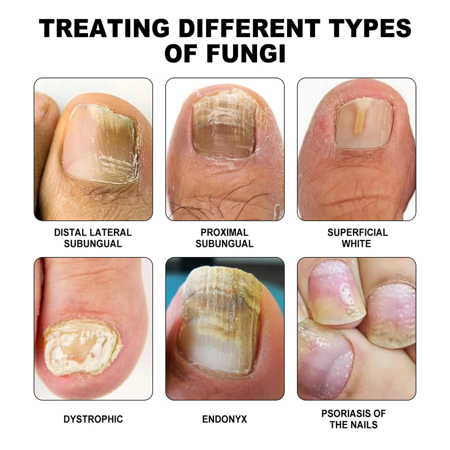 Nail Phototherapy Device — Healthier-Looking Nails at Home
