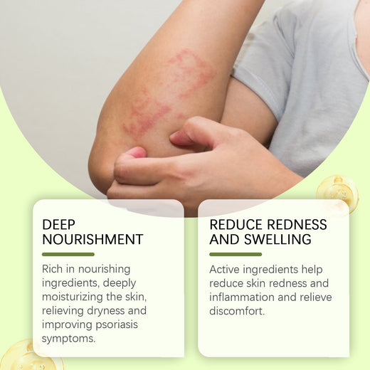 Bee Venom Cream for Psoriasis Redness & Dry Skin Relief