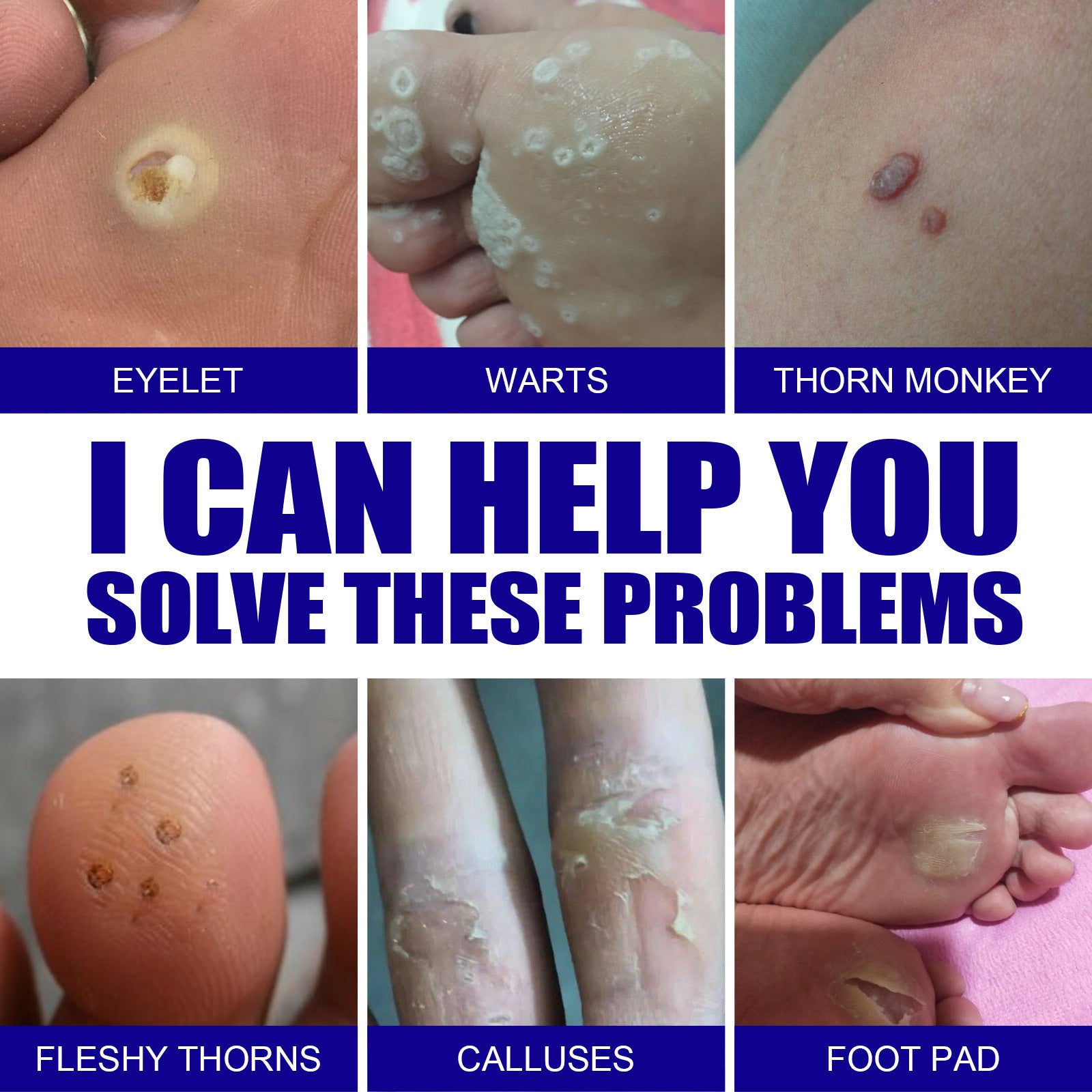 Six-panel comparison grid showing diverse skin conditions: eyelet, warts, thorn monkey, fleshy thorns, calluses, and foot pad with bold blue banner stating 'I CAN HELP YOU SOLVE THESE PROBLEMS'