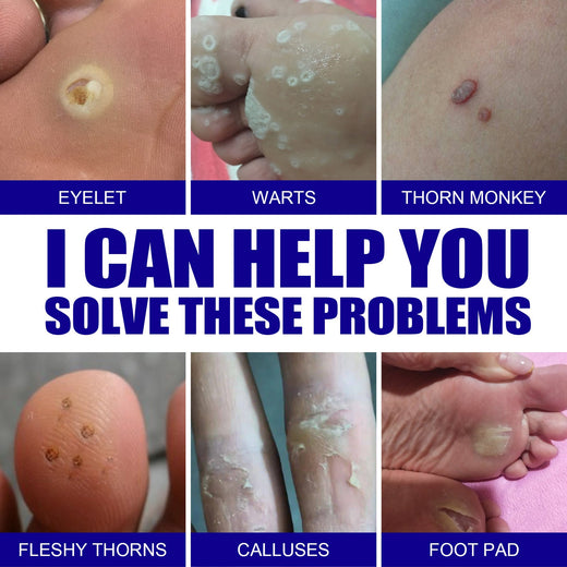 Wart Remover Ointment — Safe Removal of Warts, Skin Tags