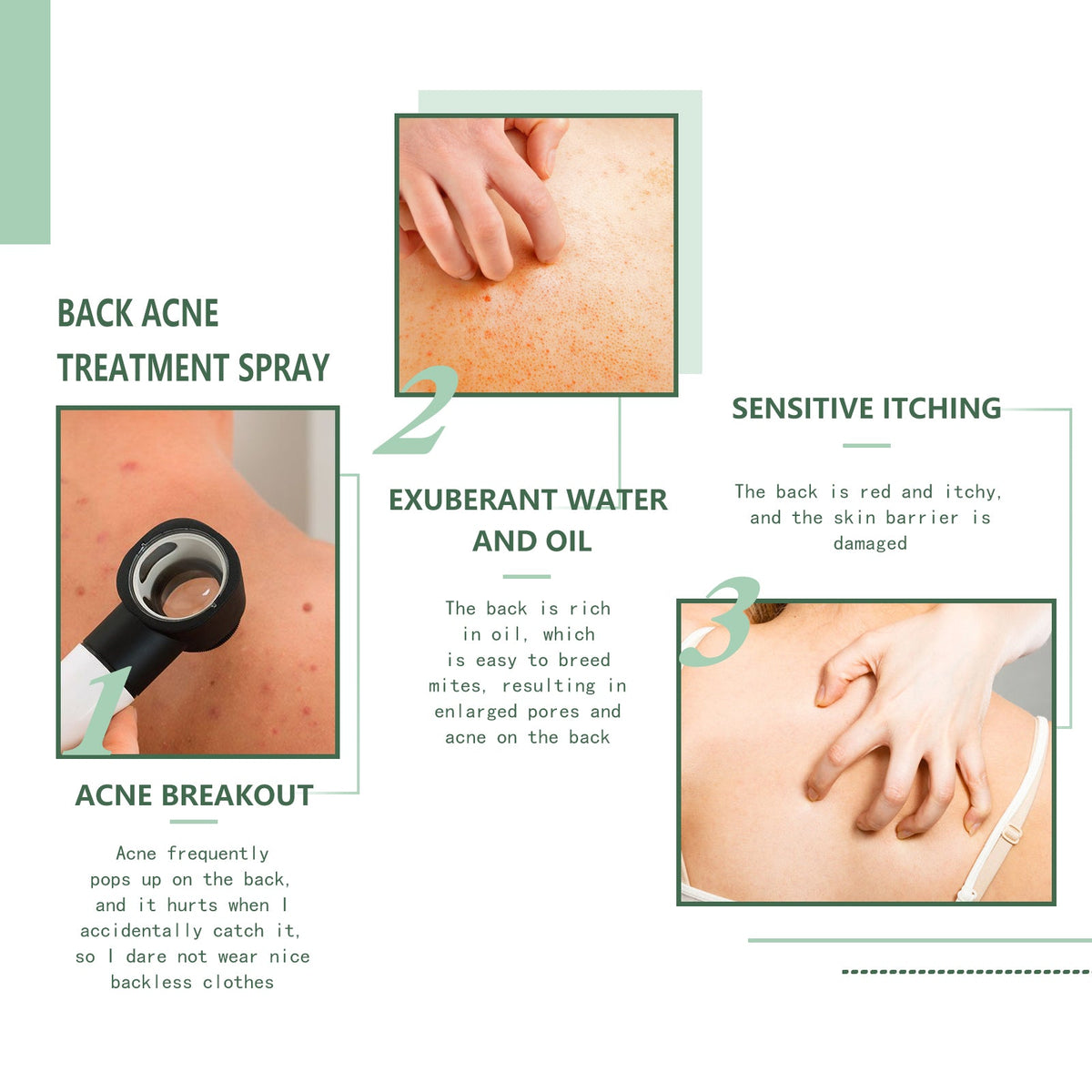 Body Acne Spray for Back, Chest & Shoulder Breakouts