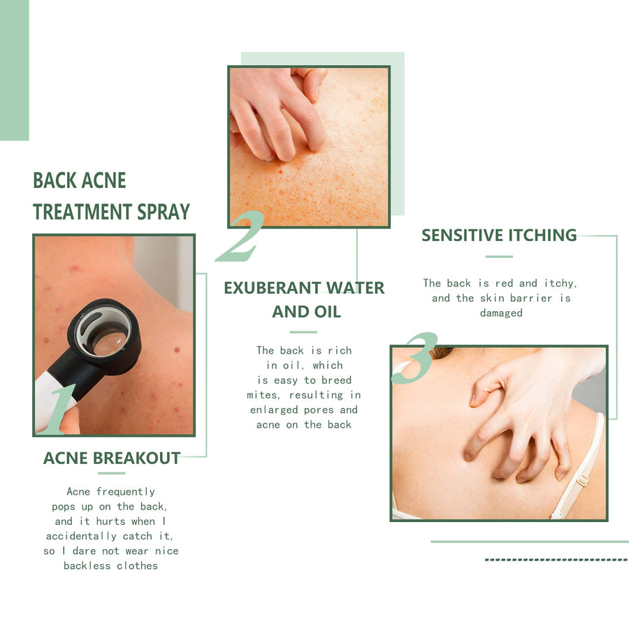Body Acne Spray for Back, Chest & Shoulder Breakouts