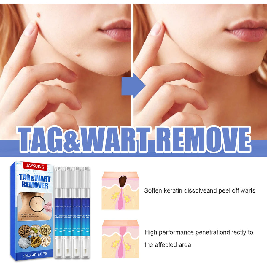 Wart Remover Pens for Targeted At-Home Skin Care