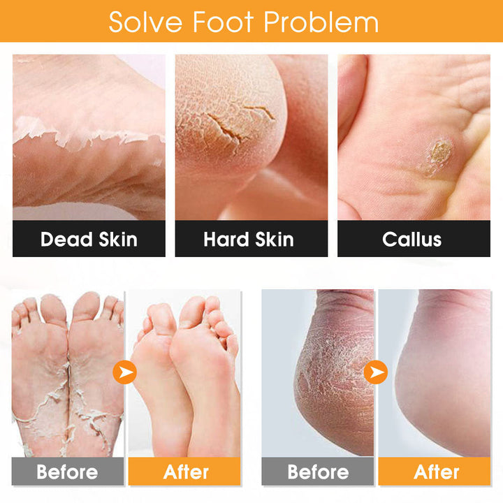Foot Callus Remover Kit - 22 Piece Professional Pedicure Tools