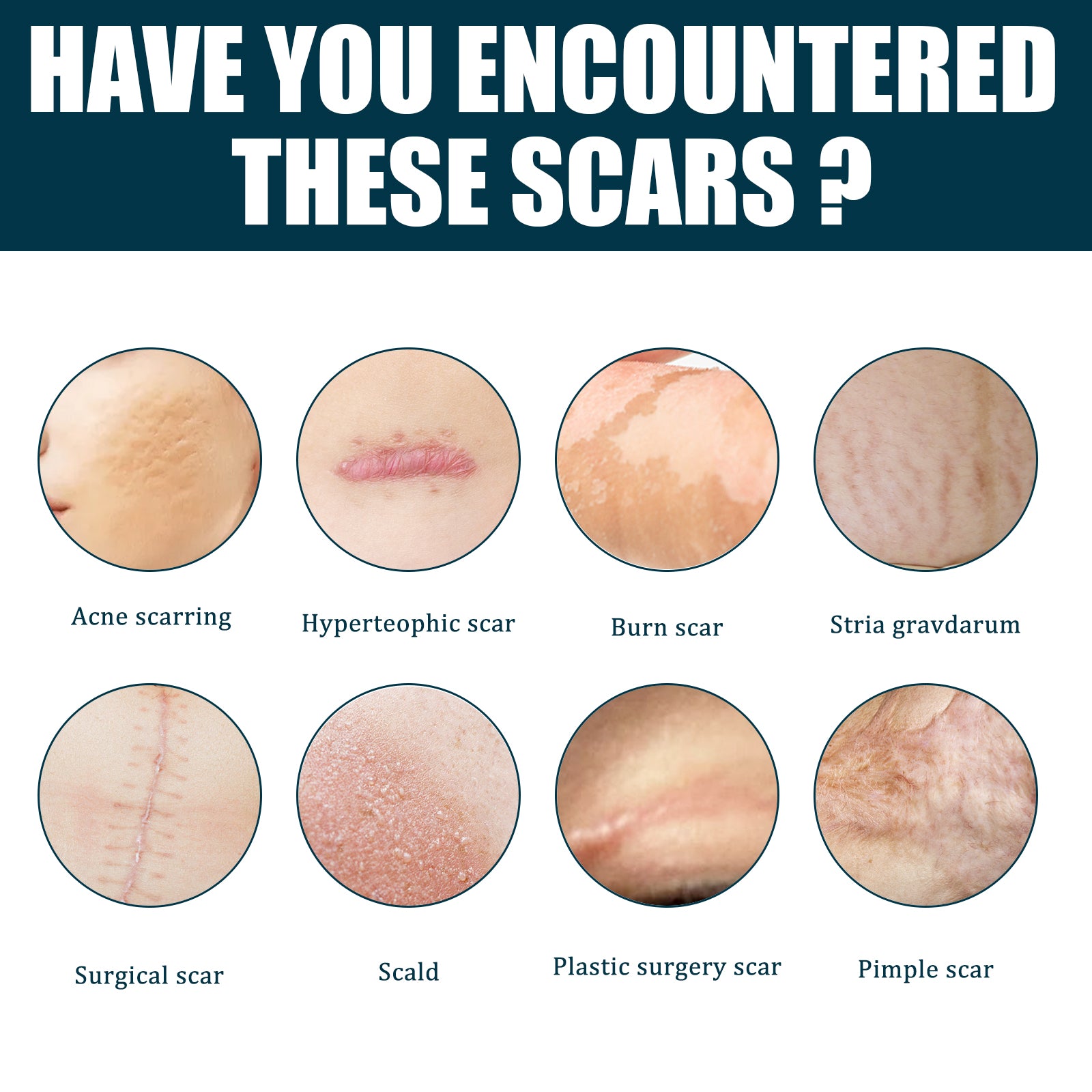 Educational grid showing 8 types of scars in circular close-up format: acne scarring, hypertrophic scar, burn scar, striae gravdarum, surgical scar, scald, plastic surgery scar, and pimple scar with text 'Have you encountered these scars?'