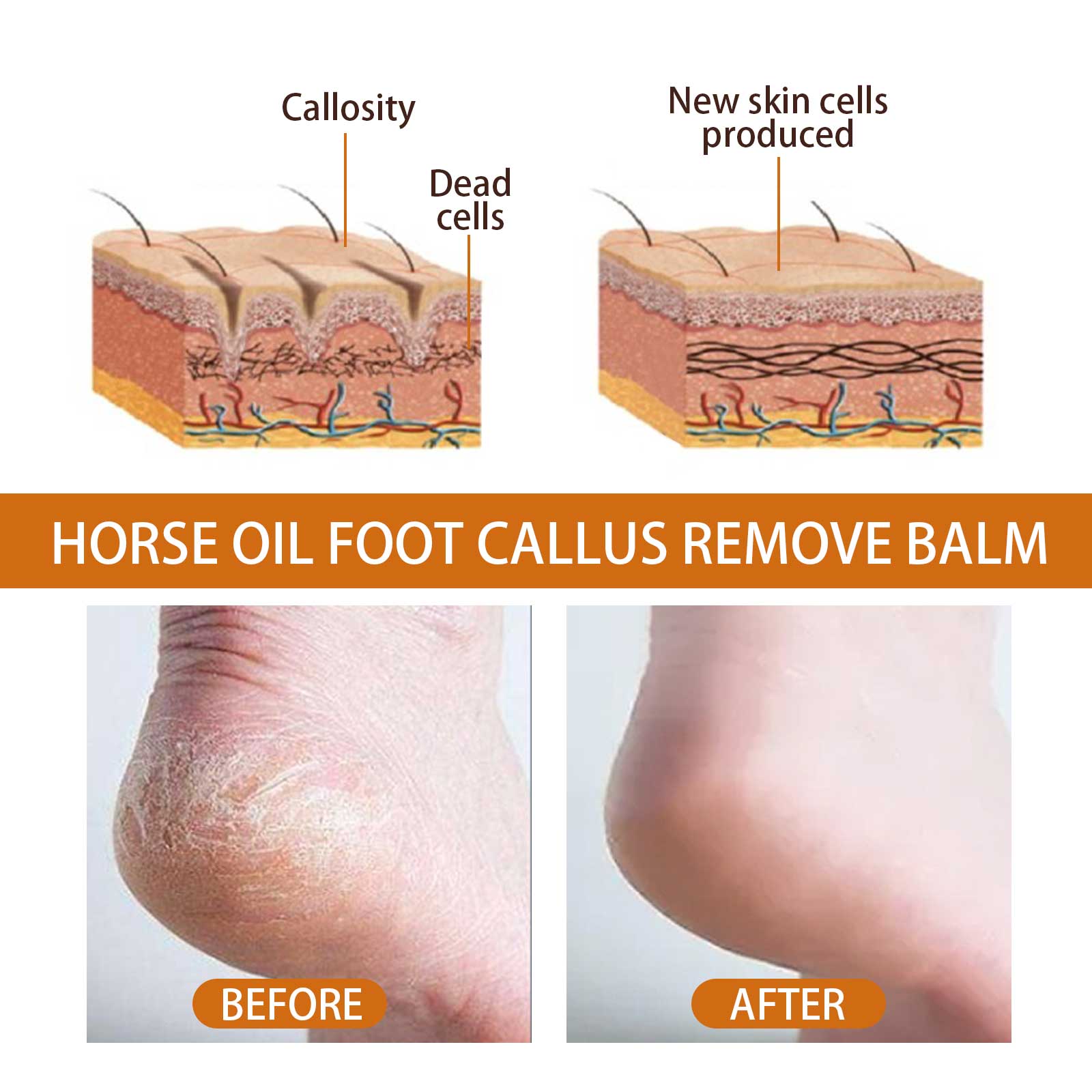 Scientific illustration of skin layers showing callosity, dead cells, and new skin cell production with before/after heel photos