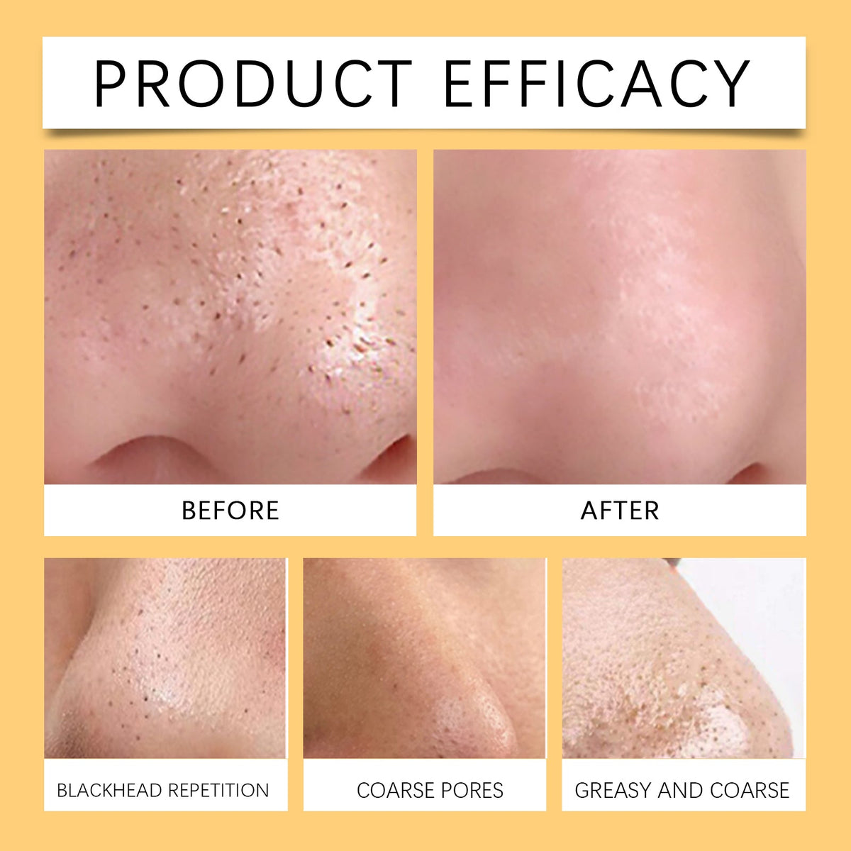 Hydrocolloid Nose Patches for Cleaner-Looking Pores