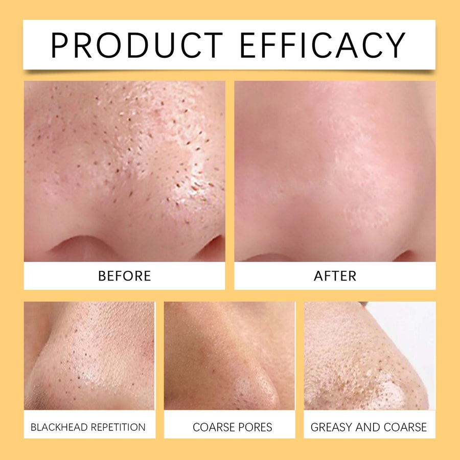 Hydrocolloid Nose Patches for Cleaner-Looking Pores