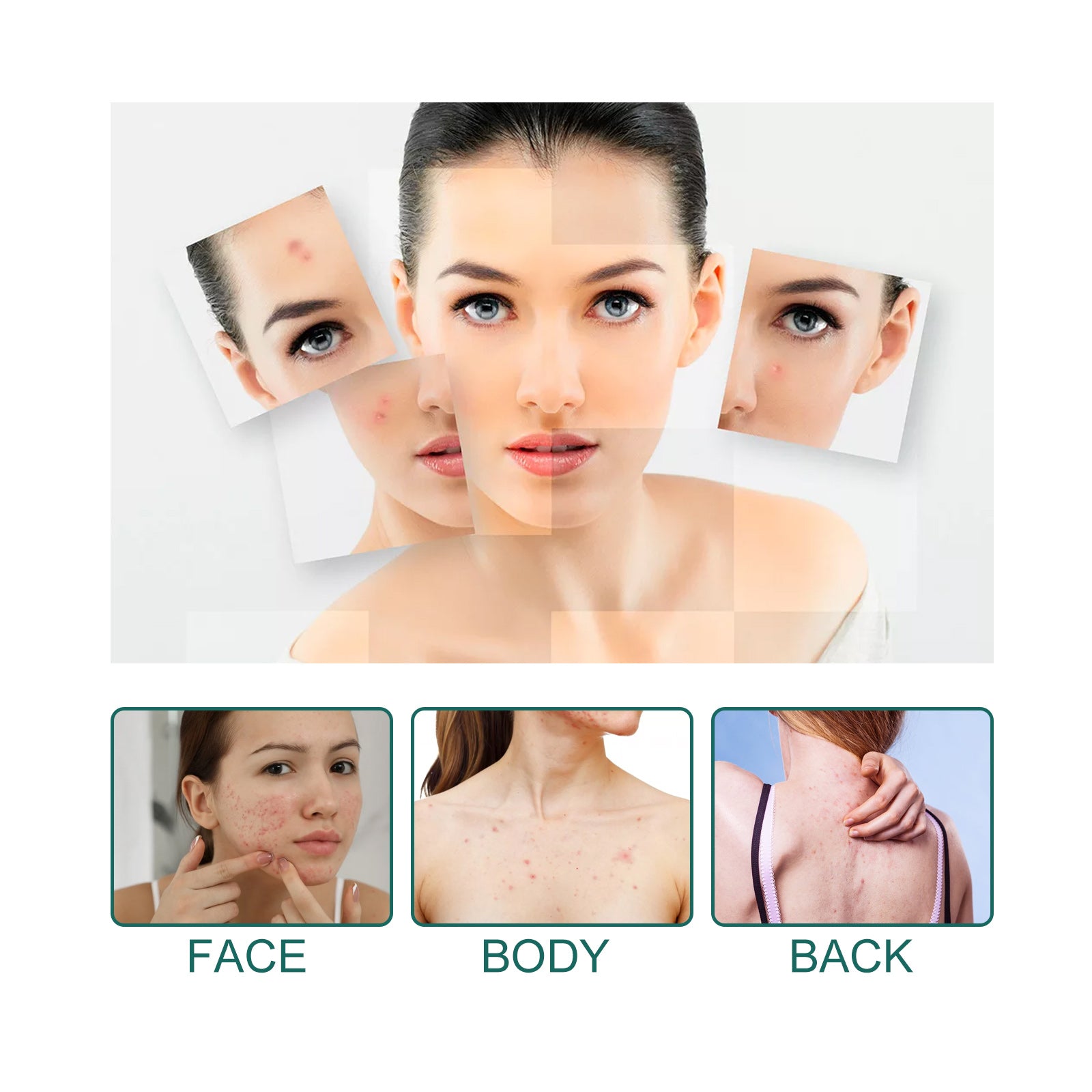 Side-by-side before/after comparison showing significant acne reduction; full face portrait with patches applied and clear skin result; packaging and patch sheets displayed