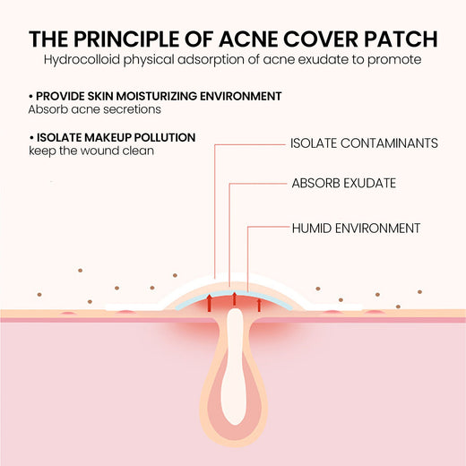 Hydrocolloid Acne Patches for Gentle Blemish Coverage