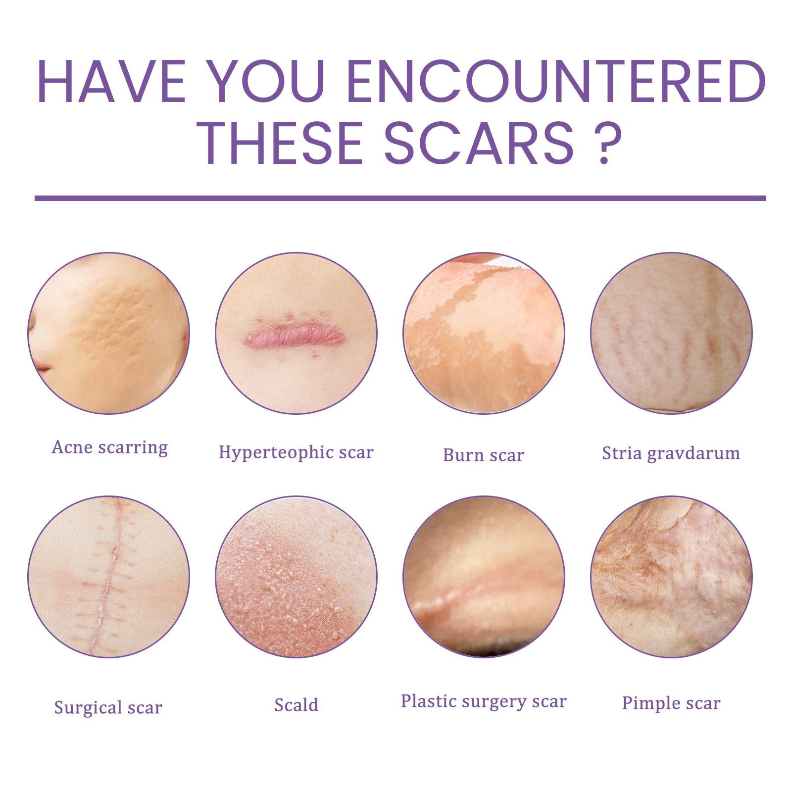 Comprehensive scar type guide showing eight different scar categories with close-up photography: acne scarring, hypertrophic scar, burn scar, stria gravdarum, surgical scar, scald, plastic surgery scar, and pimple scar