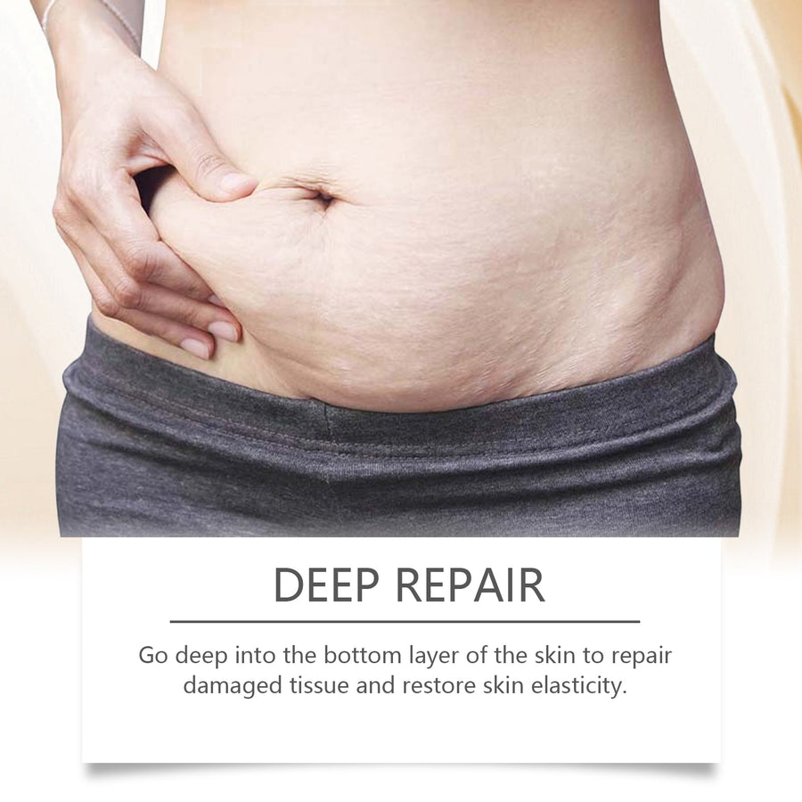 Ouhoe Stretch Mark Oil - Fades Marks, Restores Elasticity