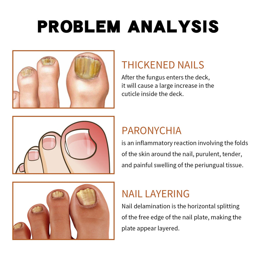 Nail Treatment Oil — Relieves In‑Growing Toenails