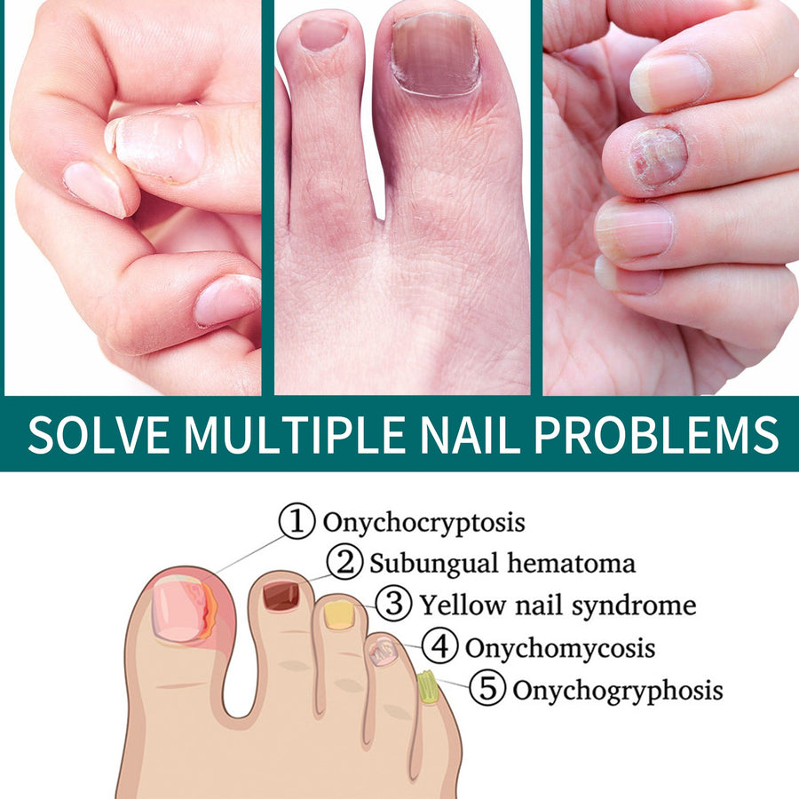 Toenail Fungus Treatment Roll-On - Visible Results in 7 Days