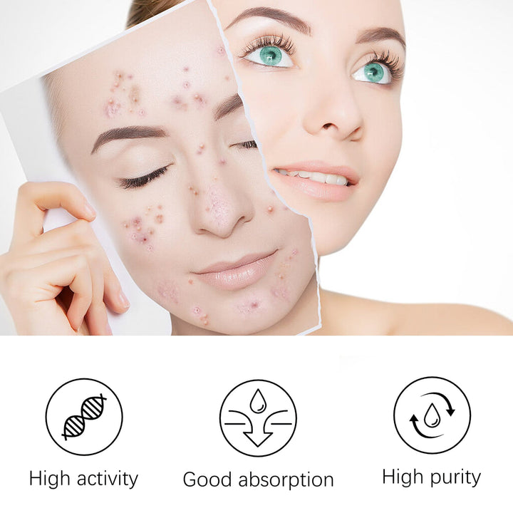 Tea Tree Acne Serum for Clear Skin & Tight Pores