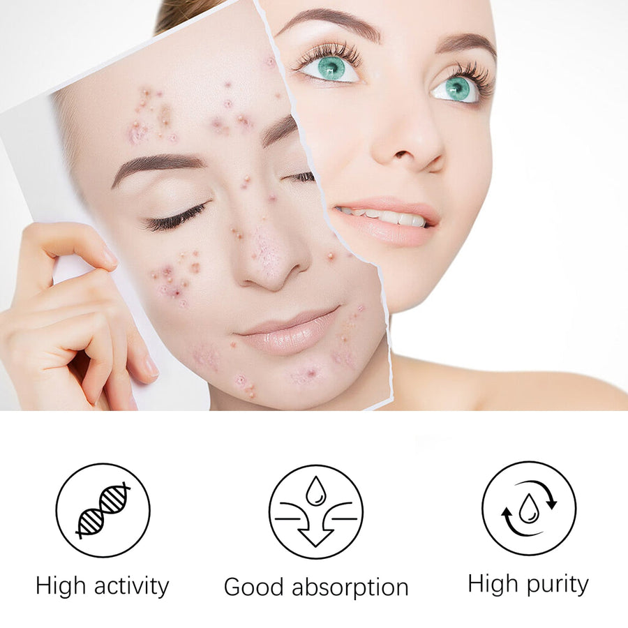 Tea Tree Acne Serum for Clear Skin & Tight Pores