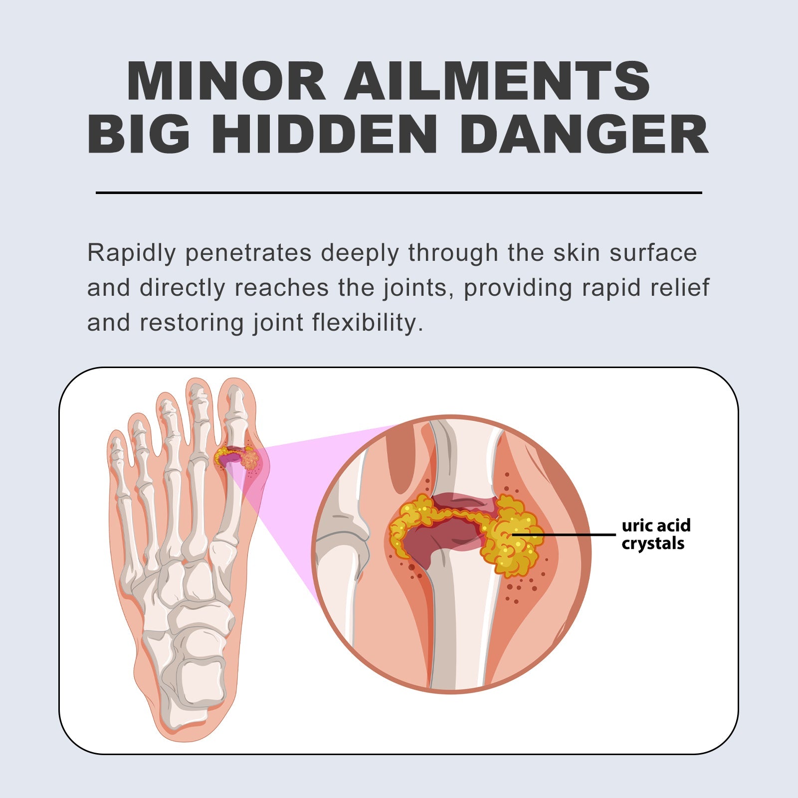 Educational infographic titled 'Minor Ailments Big Hidden Danger' showing foot anatomy, joint cross-section with uric acid crystals highlighted