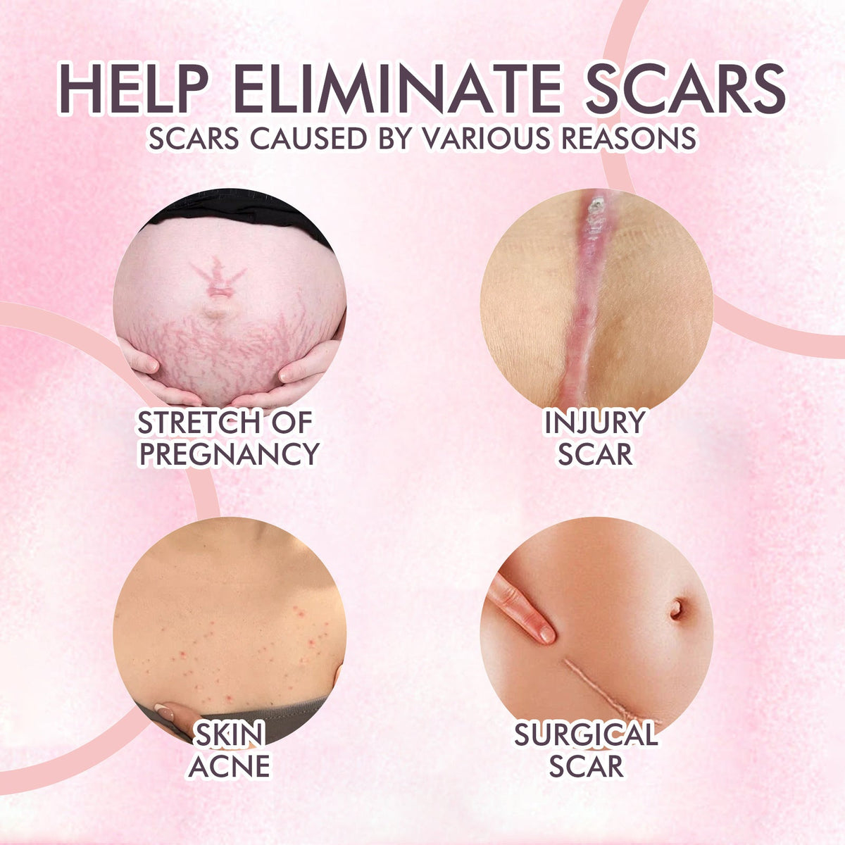 Body Oil for Stretch Marks, Scars & Fine Lines Repair