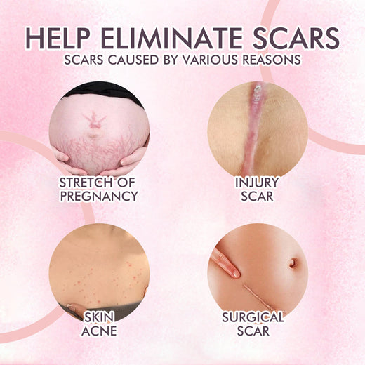 Body Oil for Stretch Marks, Scars & Fine Lines Repair