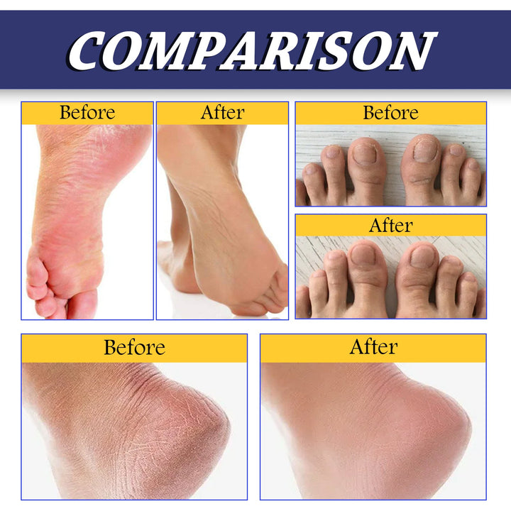 Tea Tree Oil Foot Balm — Heal Cracked Heels & Dry Skin