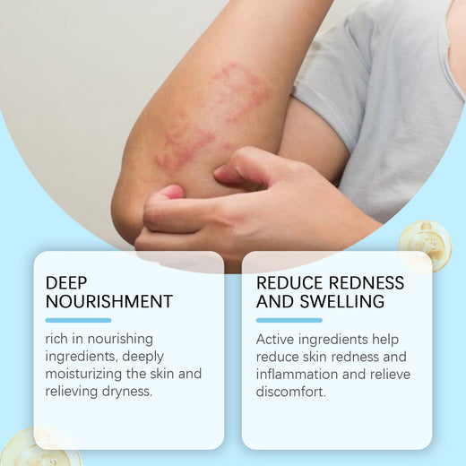 OceAura Antifungal Cream — Plant-Based Itch Relief