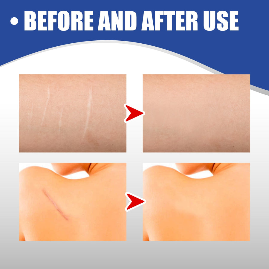Silicone Scar Sheets for Smooth, Less Visible Scars