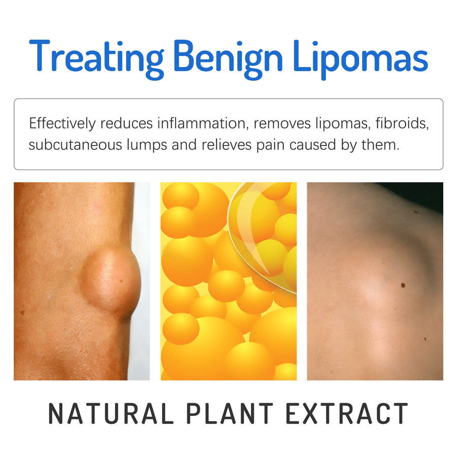South Moon Lipoma Cream — Dissolves Benign Lumps Naturally