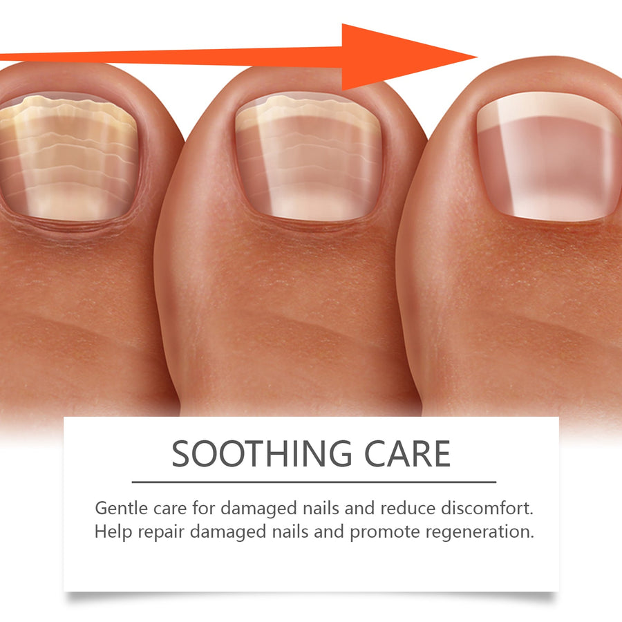Herbal Nail Repair Solution for Thick Discolored Nails