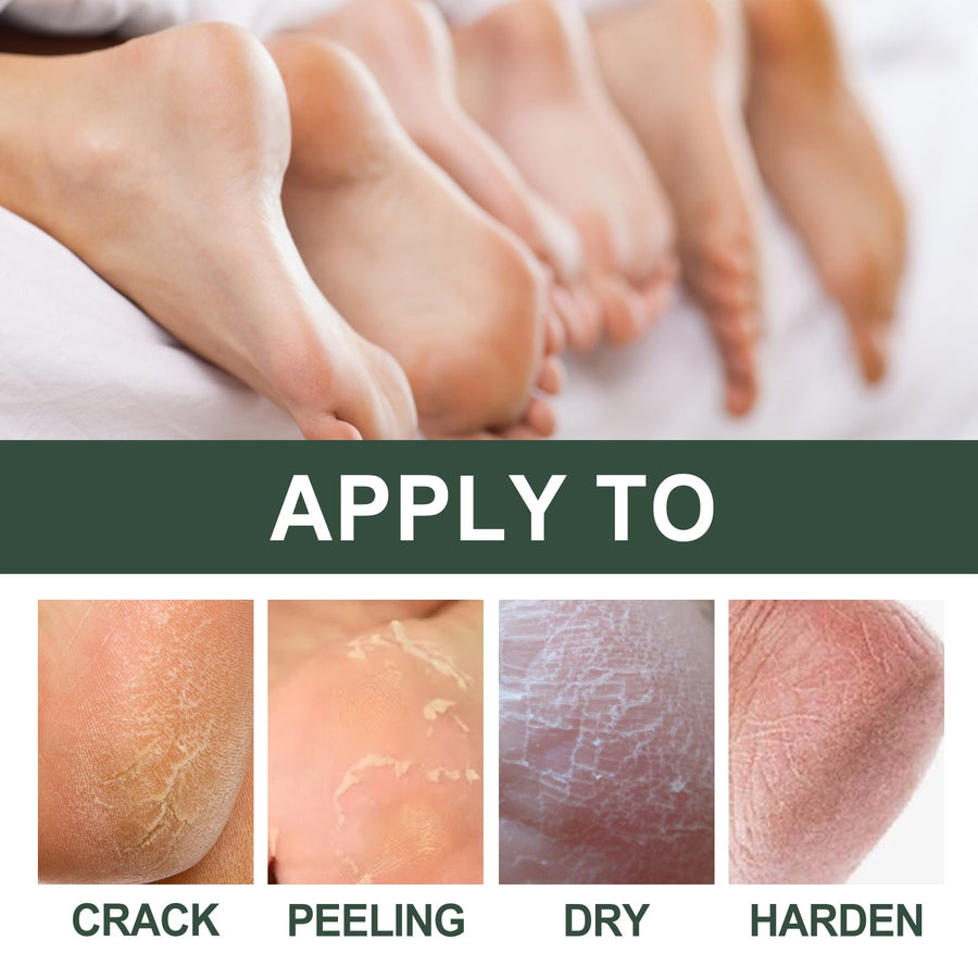 Cracked Heel Cream for Softer Hands, Feet & Calluses