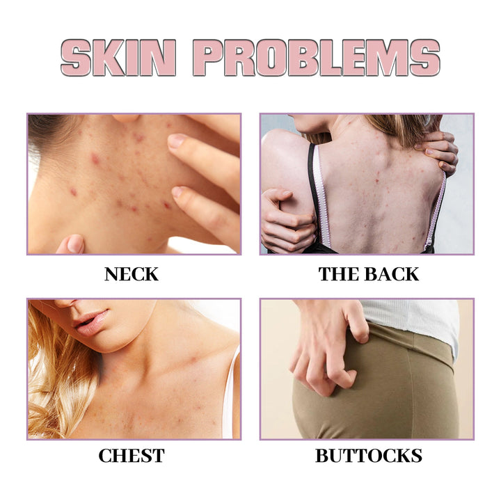 Body Acne Roll-On Serum for Back, Chest & Neck