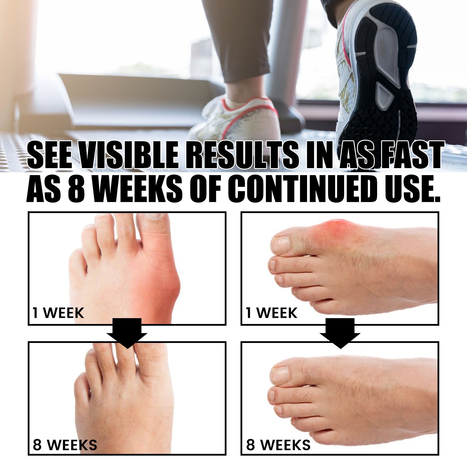 8-week transformation timeline showing dramatic reduction in bunion swelling and foot inflammation with athletic lifestyle context
