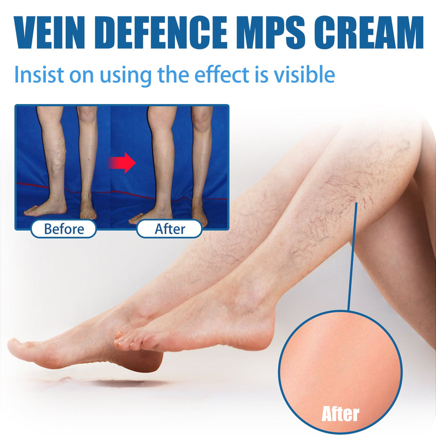 Vein Defence MPS Cream — Visibly Reduce Veins & Swelling