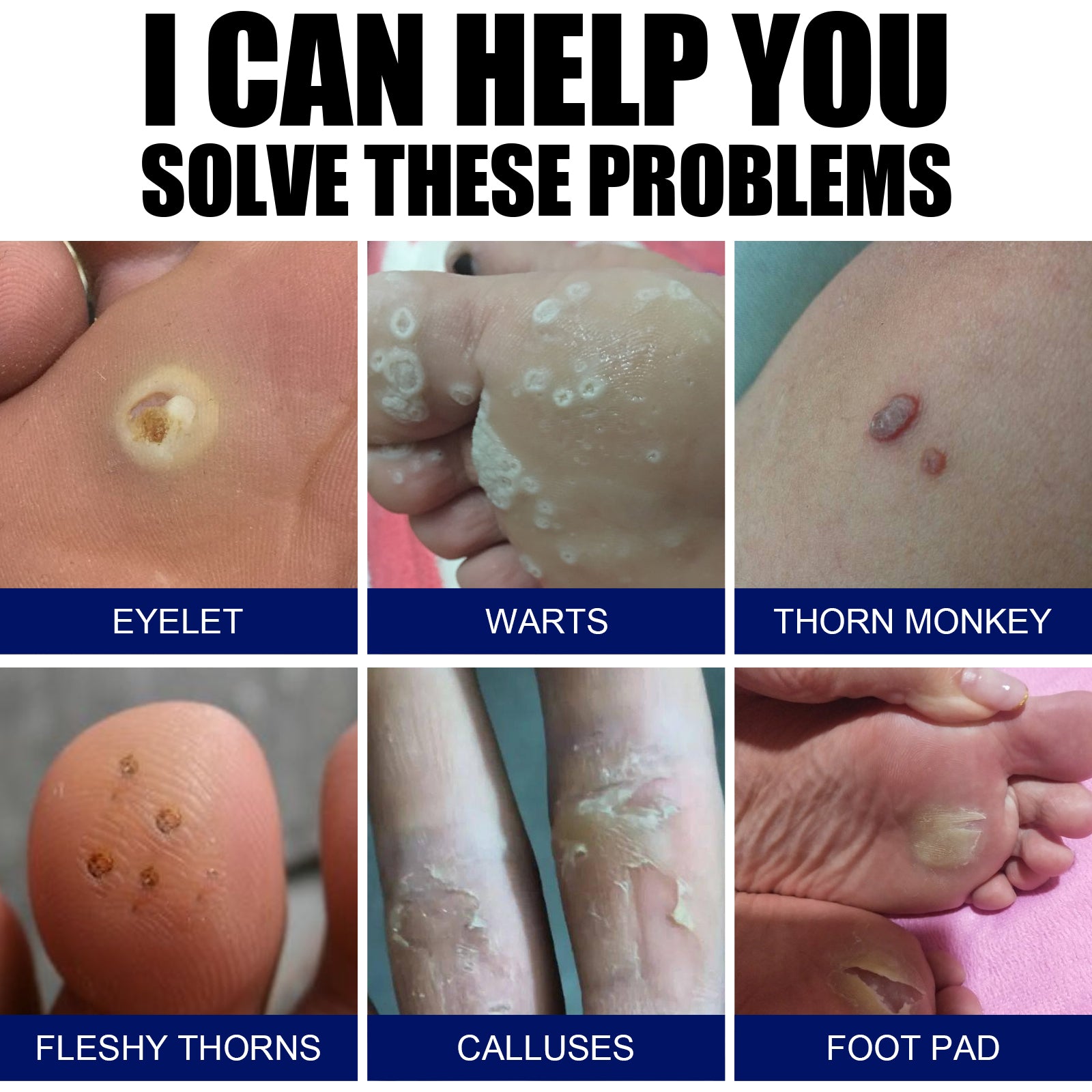 Grid of six images showing eyelet, warts cluster, thorn monkey lesion, fleshy thorns on fingertip, calluses on legs, and foot pad growth with clinical labels