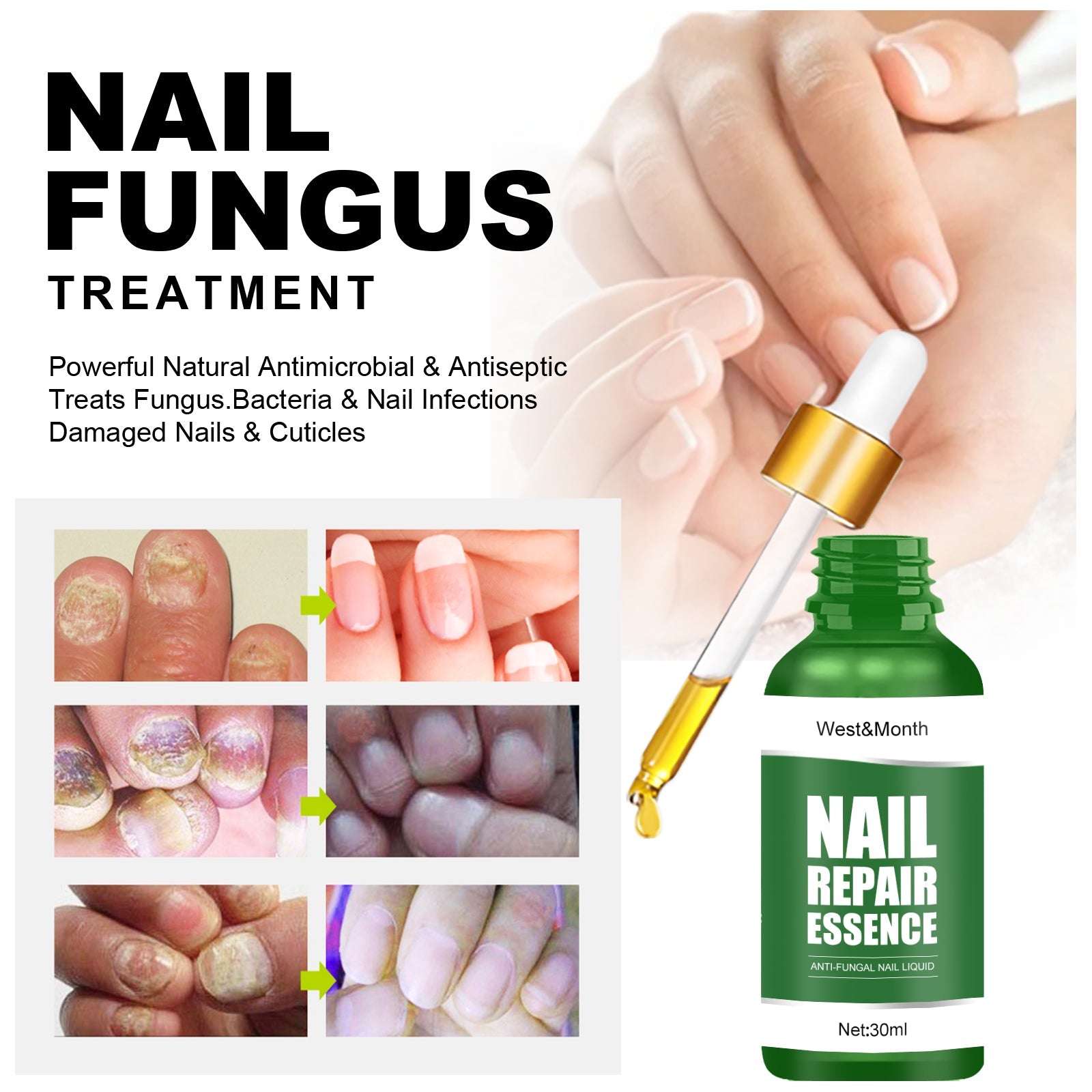 Clinical before/after grid showing severe fungal nail infections (yellow, thick, textured nails) transforming to clear healthy pink nails across 6 progression stages with green checkmark indicators