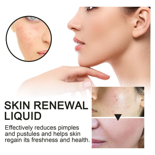 2% BHA Acne Treatment Liquid for Clogged Pores & Breakouts