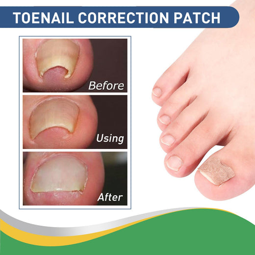 Toenail Correction Patches for Curved, Ingrown Nails