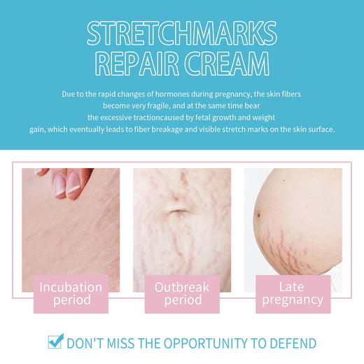Stretch Mark Repair Cream for Pregnancy Skin Recovery
