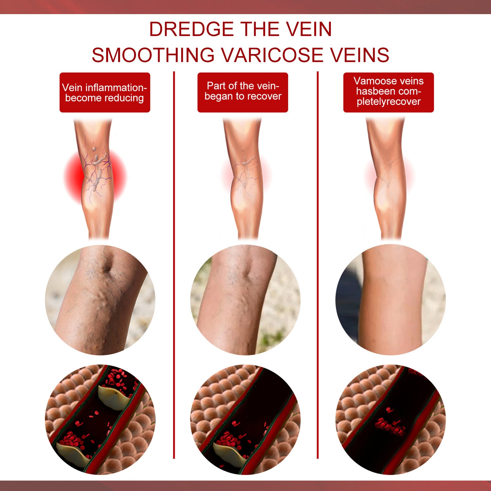 Three-stage progression graphic titled 'Dredge the Vein Smoothing Varicose Veins' showing leg photographs, magnified vein detail circles, and cellular-level treatment visualization