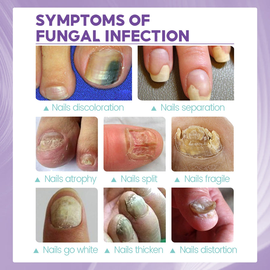 Nail Fungus Spray for Soothing Cooling Daily Nail Care