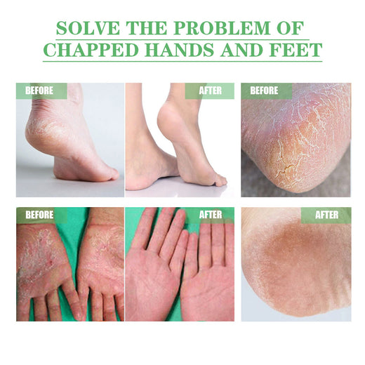 Cracked Heel Repair Cream for Dry Hands and Feet