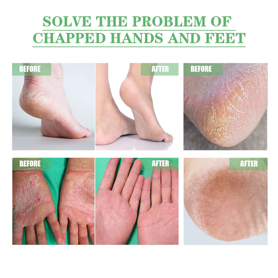 Cracked Heel Repair Cream for Dry Hands and Feet