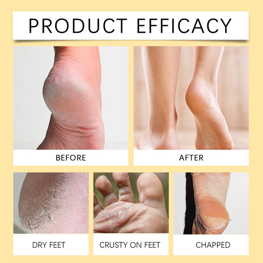Coconut Foot Cream for Dry Cracked Heels & Feet