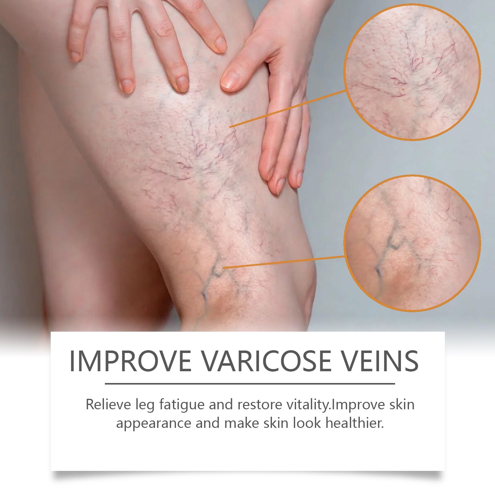 Close-up magnified circles highlighting varicose vein patterns on leg skin with text overlay 'IMPROVE VARICOSE VEINS'