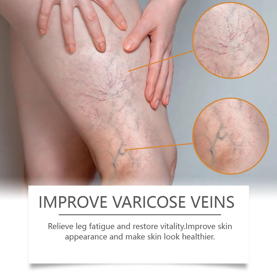 Horse Chestnut Leg Gel — Reduces Varicose Veins & Relieves