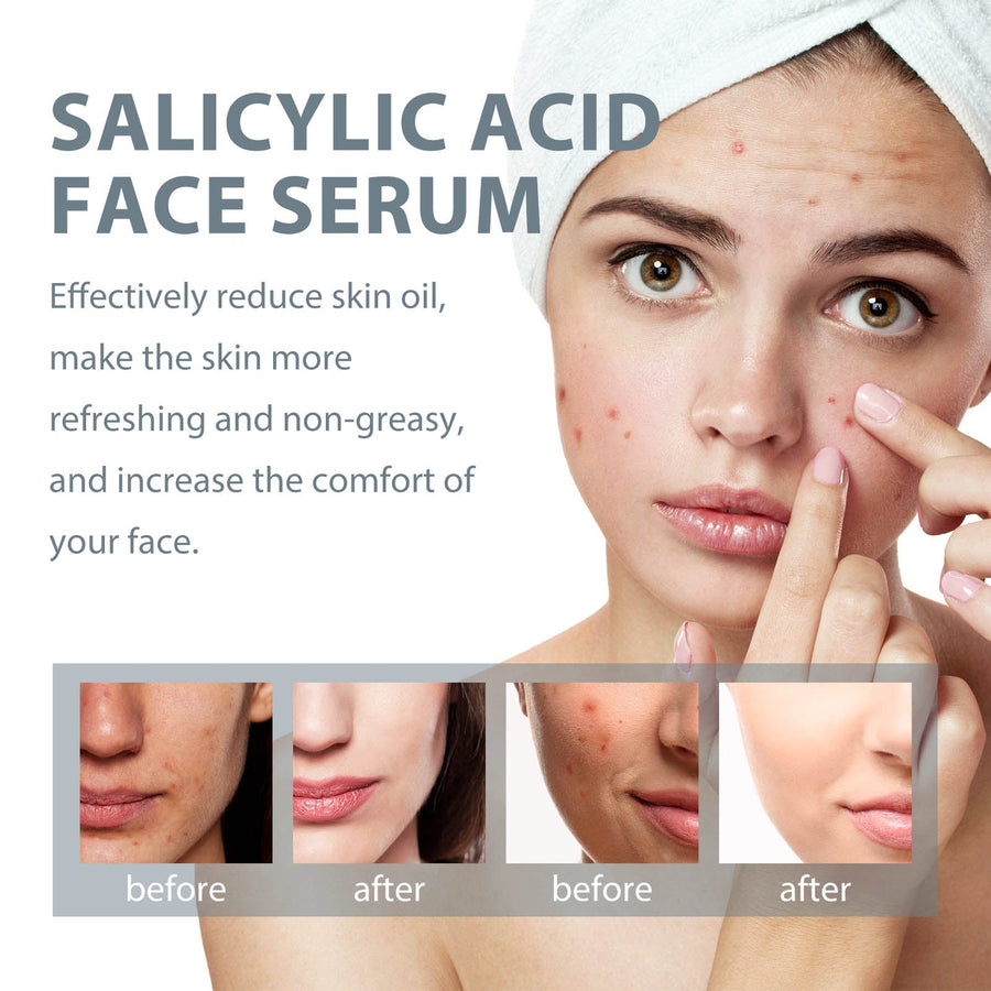 Salicylic Acid Facial Essence, Lighten Acne Mark Repair Hydr