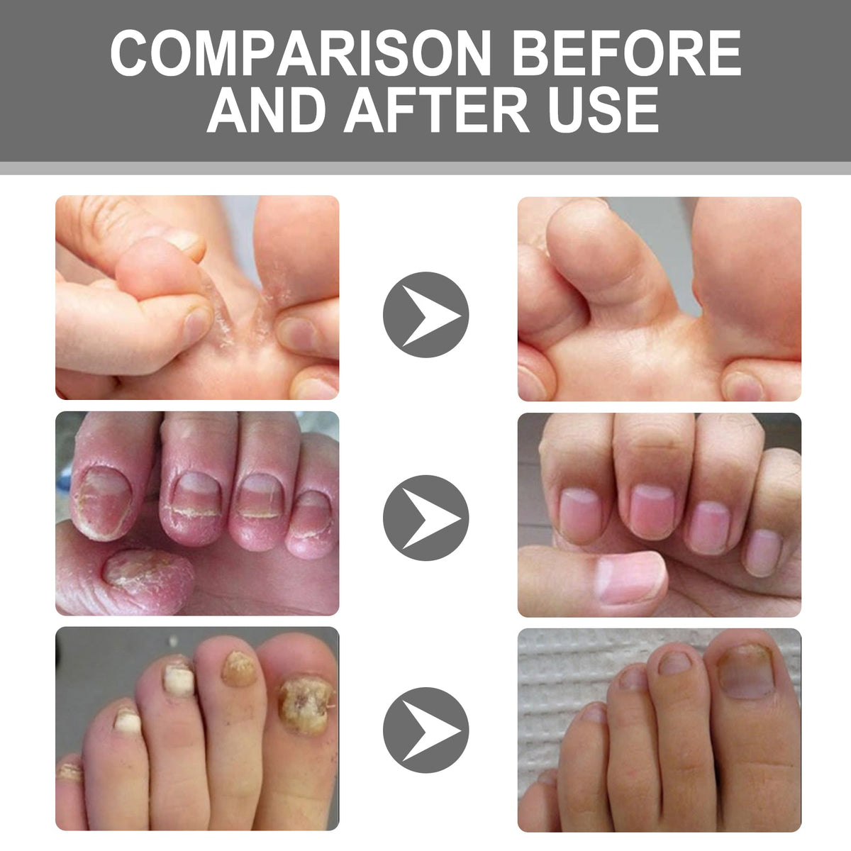 Nail Repair Cream for Thick Discolored Damaged Nails