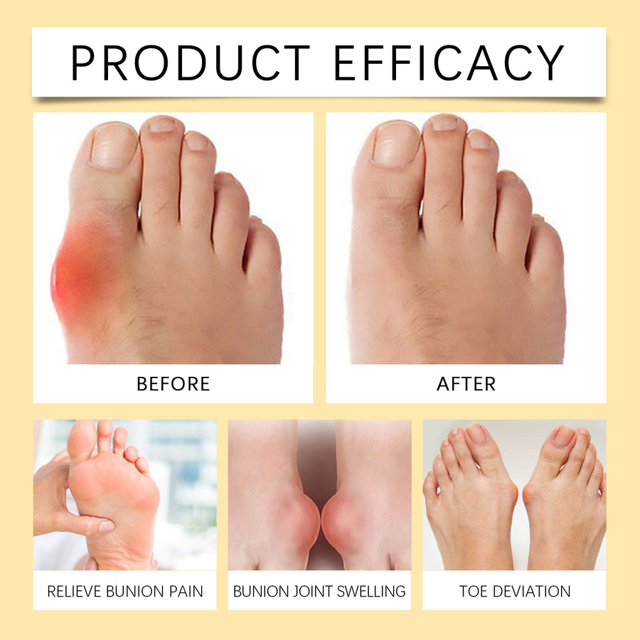 Bee Venom Bunion Relief Cream — Natural Joint Pain Relief