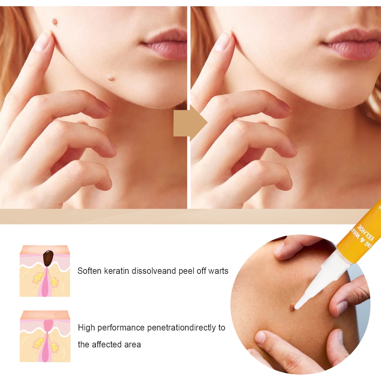 Before-after side-by-side of jawline showing single skin tag disappearance with arrow indicating transformation